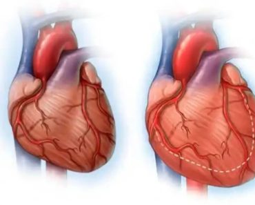 8 Medical Problems That Can Make You Develop An Enlarged Heart