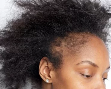 5 things that damage the hair and hairline of African women