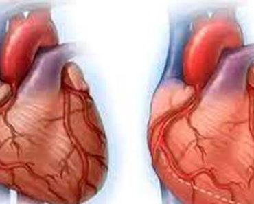Heart Disease Kills Fast: Avoid Too Much Intake Of These Three Things If You Want To Live Long