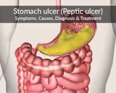 3 Things That Triggers Stomach Ulcer If Consume Excessively