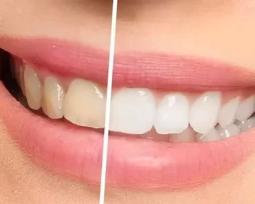 JUST IN: Smart Natural Ways You Can Remove Yellow Stains From Your Teeth